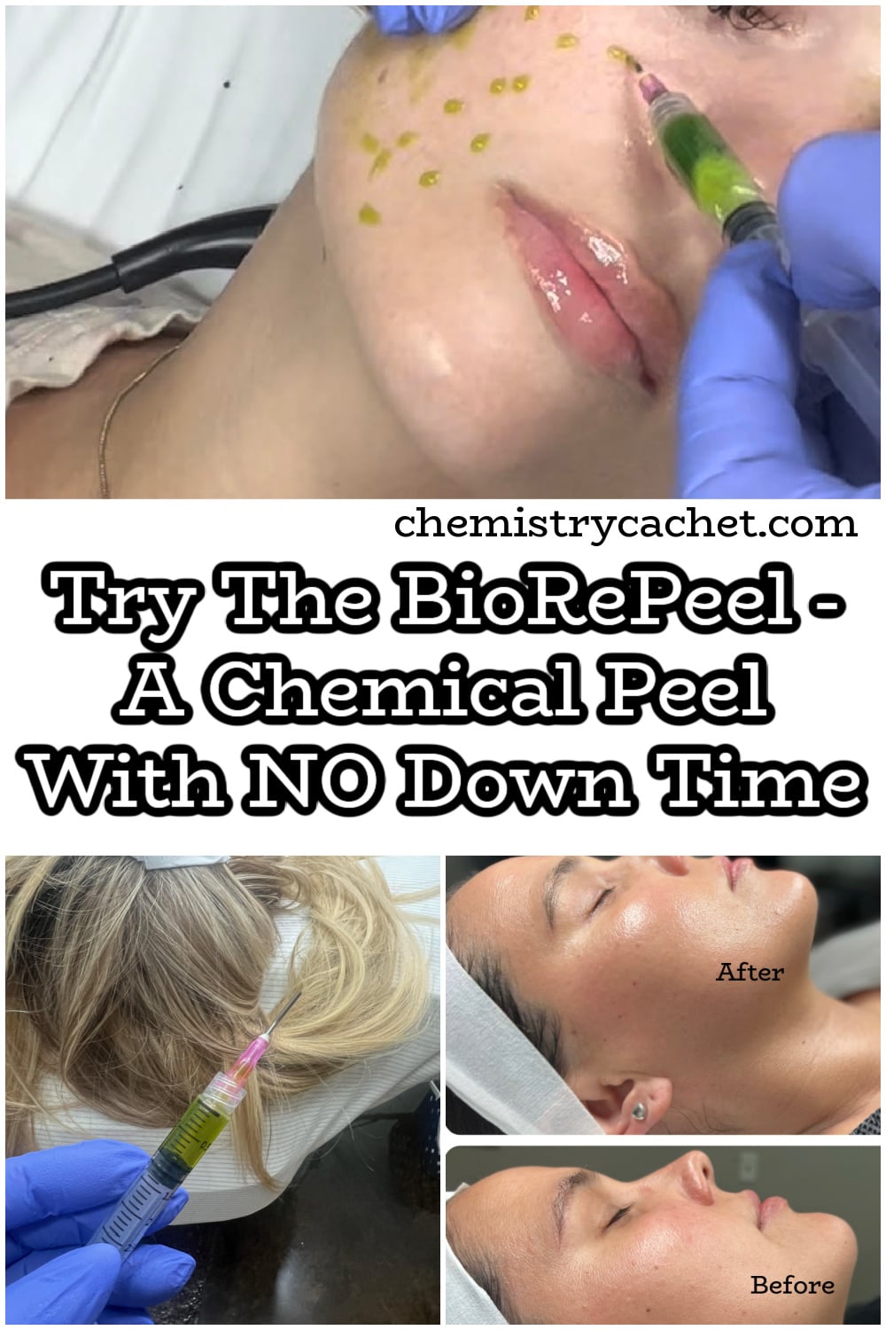 Try The BioRePeel - A Chemical Peel With NO Down Time