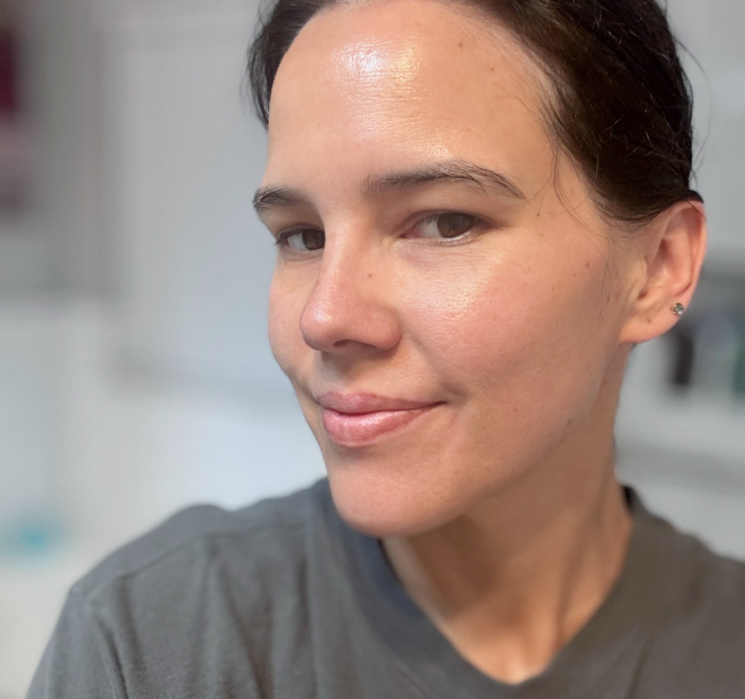 5 days after microneedling facial