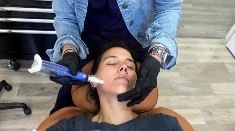 microneedling facial at Revision Aesthetics in Stephenville, Texas
