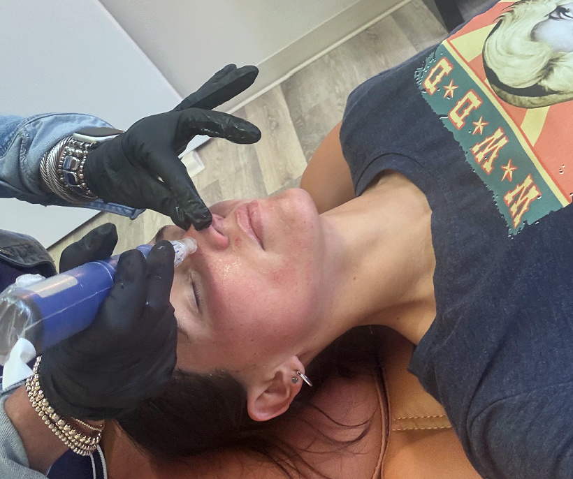 microneedling facial