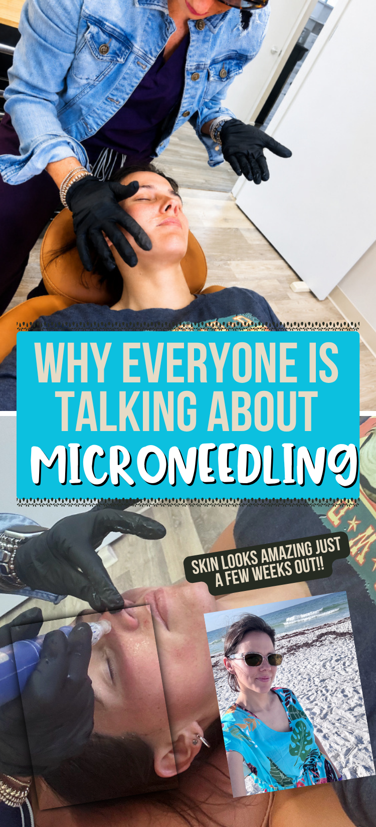 microneedling facial